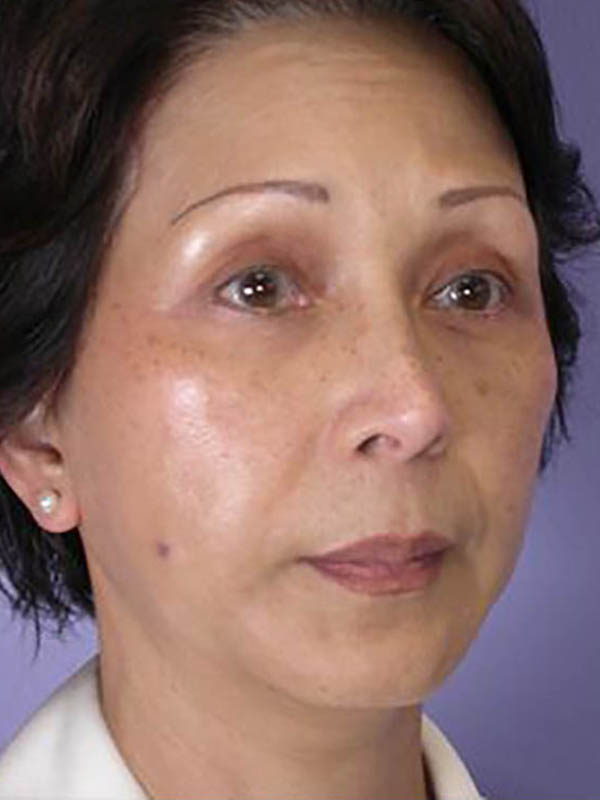 Facelift Before & After Image