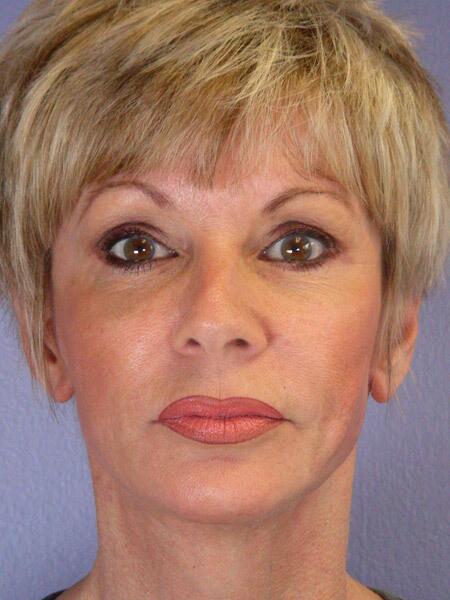 Facelift Before & After Image