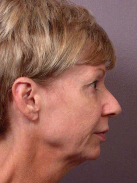 Facelift Before & After Image