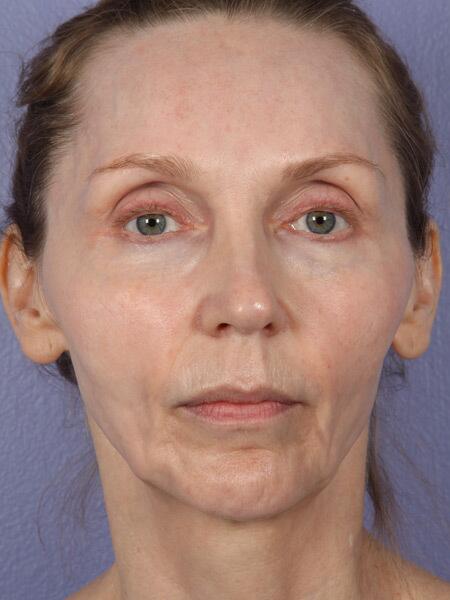 Facelift Before & After Image