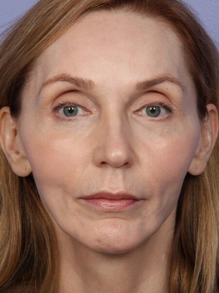 Facelift Before & After Image