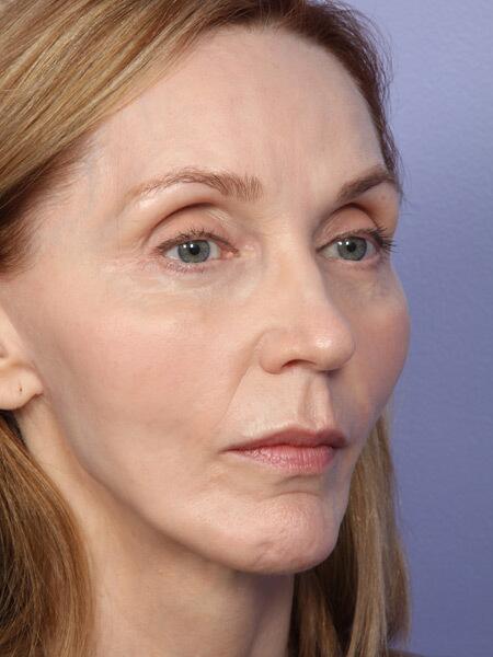 Facelift Before & After Image