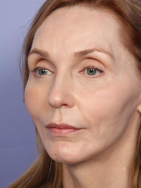 Facelift Before & After Image