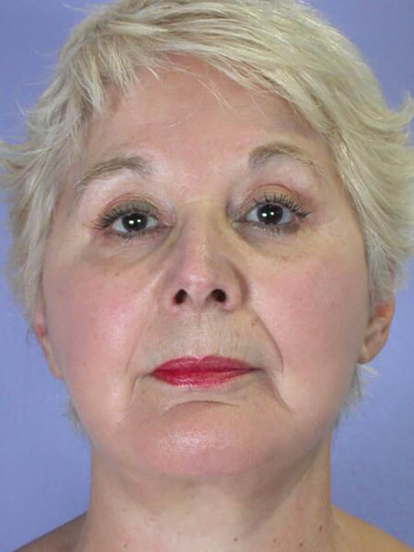 Facelift Before & After Image