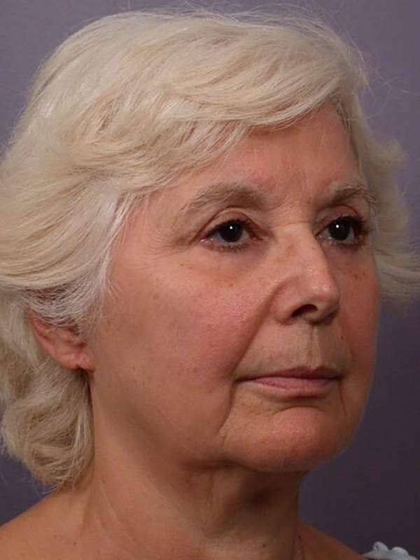 Facelift Before & After Image