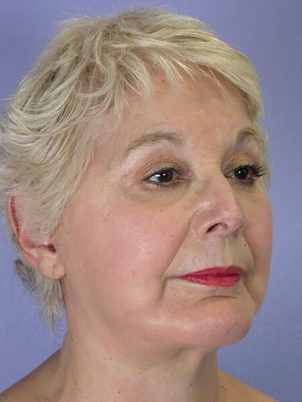 Facelift Before & After Image