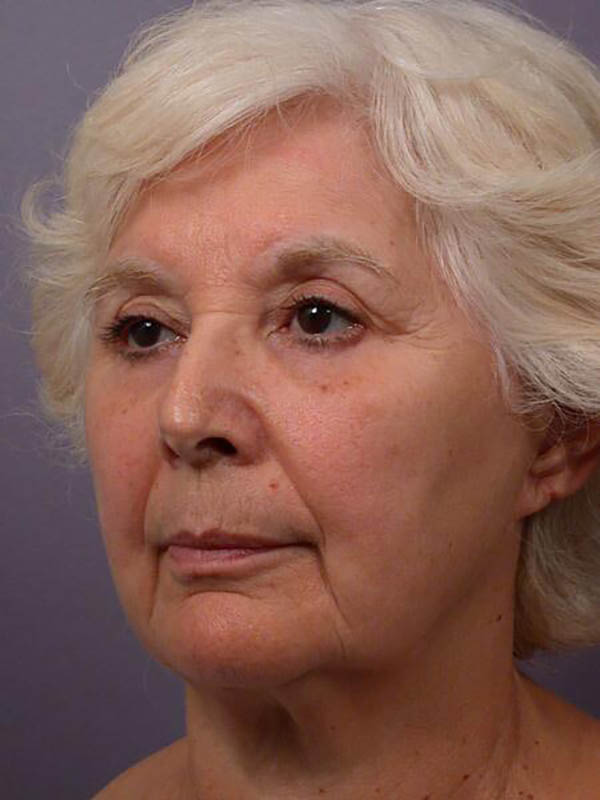 Facelift Before & After Image