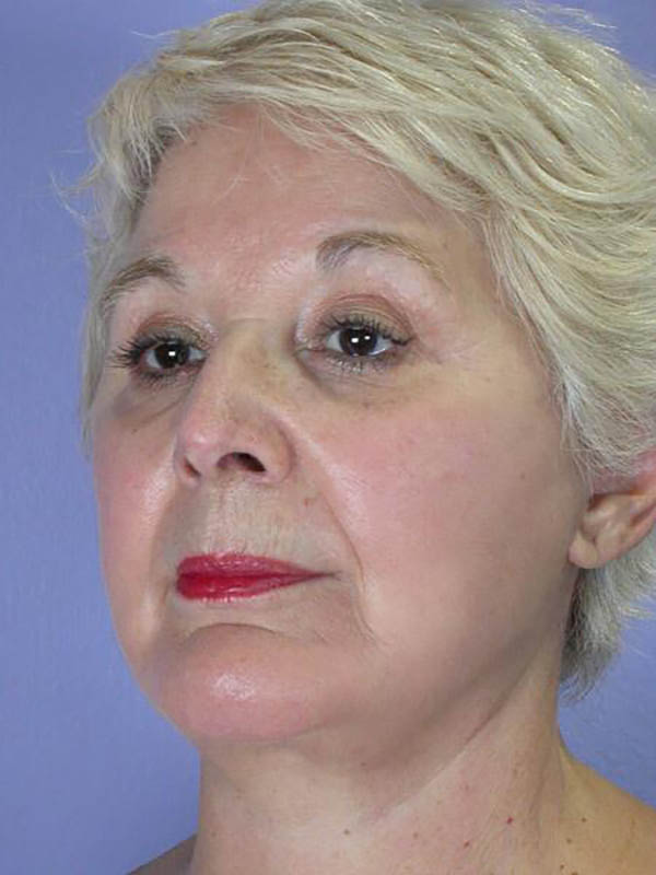 Facelift Before & After Image