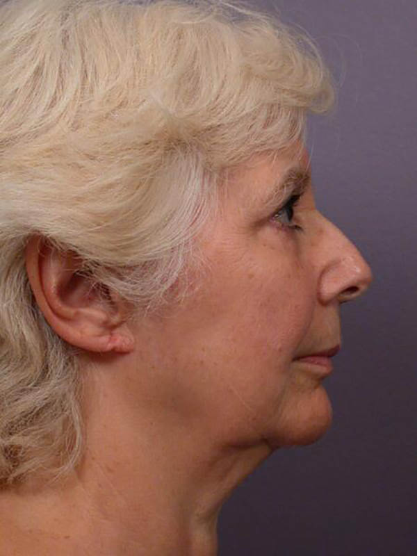 Facelift Before & After Image