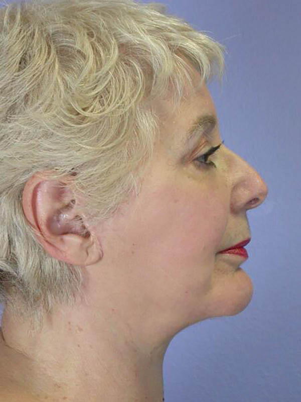 Facelift Before & After Image