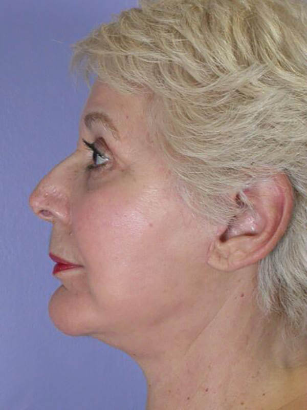 Facelift Before & After Image