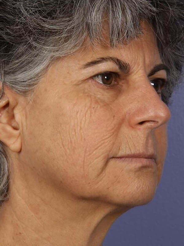 Facelift Before & After Image