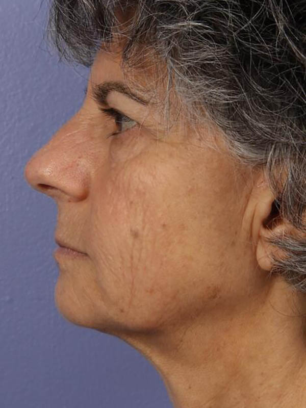 Facelift Before & After Image