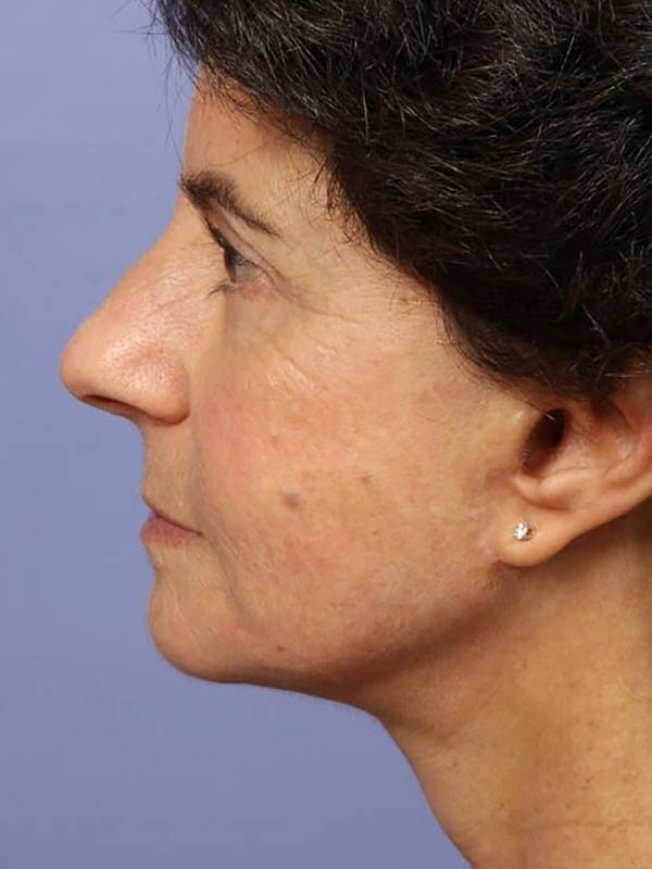 Facelift Before & After Image