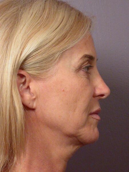 Facelift Before & After Image