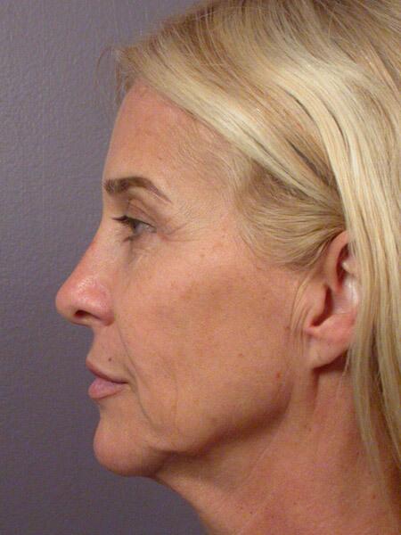 Facelift Before & After Image