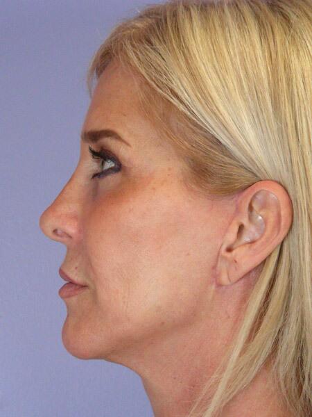 Facelift Before & After Image