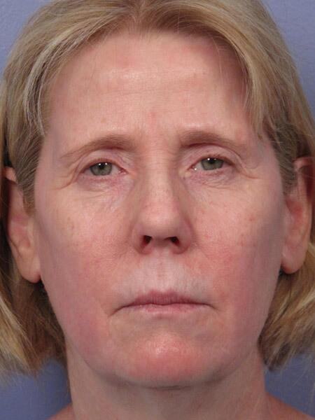 Facelift Before & After Image