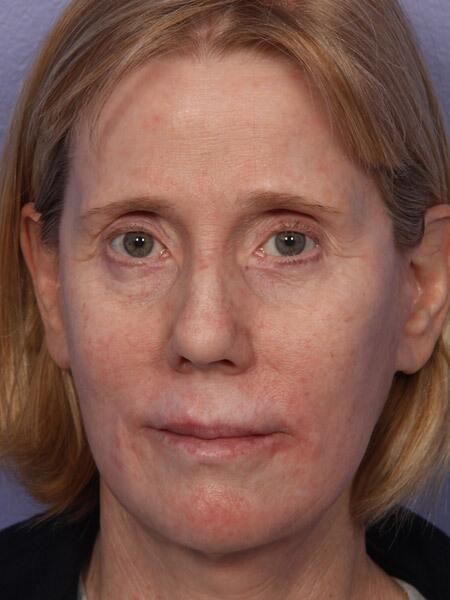 Facelift Before & After Image