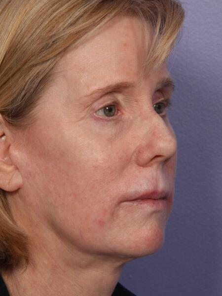 Facelift Before & After Image