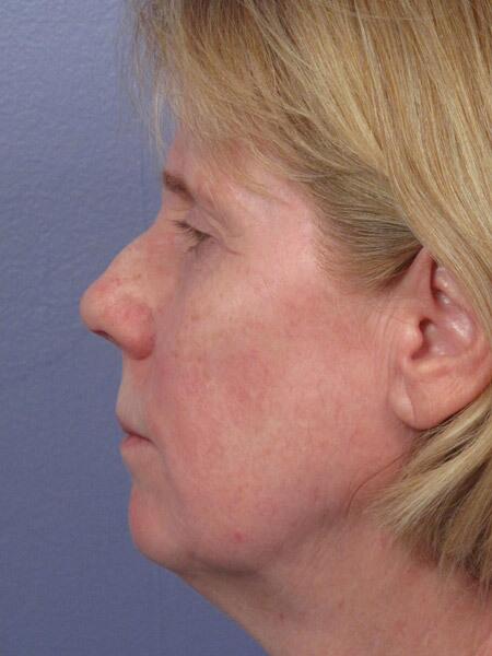 Facelift Before & After Image