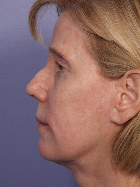 Facelift Before & After Image