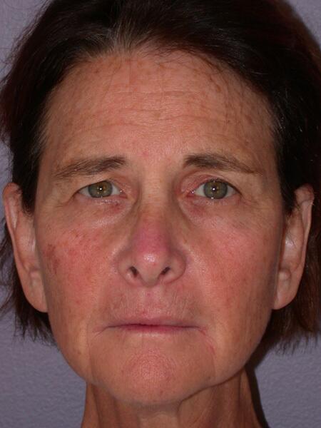 Facelift Before & After Image