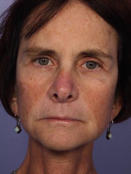 Facelift Before & After Image