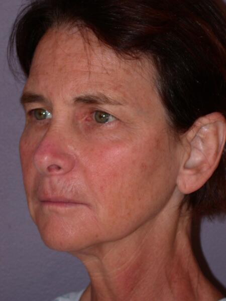 Facelift Before & After Image