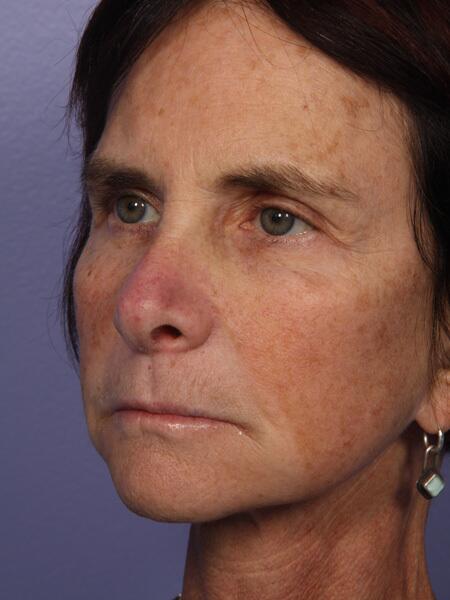 Facelift Before & After Image