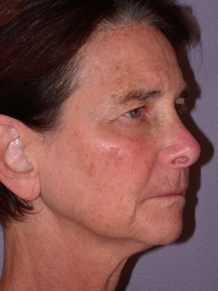 Facelift Before & After Image