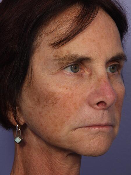 Facelift Before & After Image