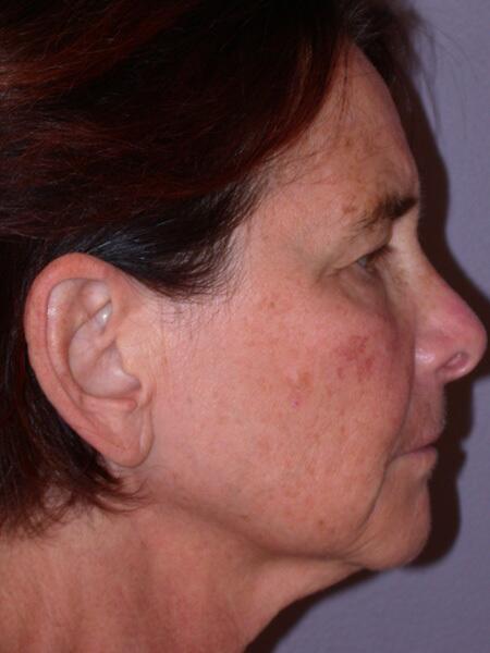 Facelift Before & After Image