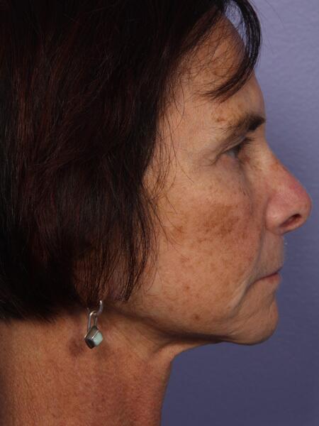 Facelift Before & After Image