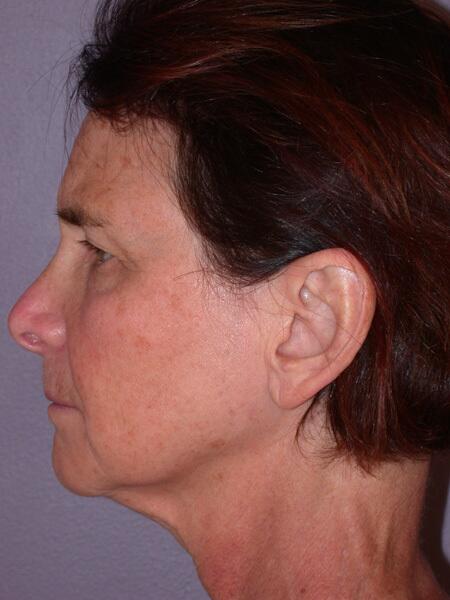 Facelift Before & After Image