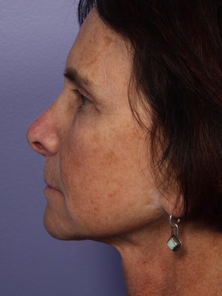 Facelift Before & After Image