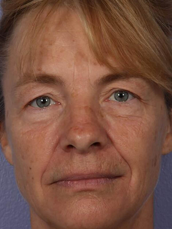 Facelift Before & After Image