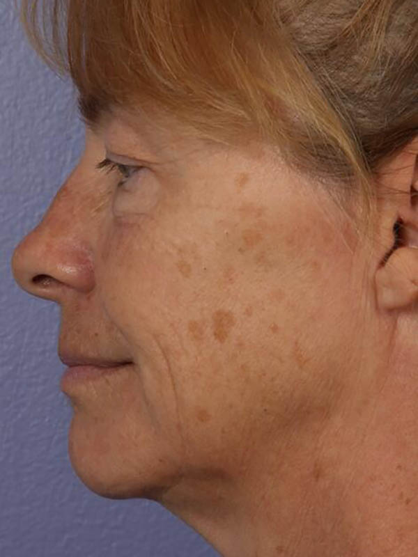 Facelift Before & After Image