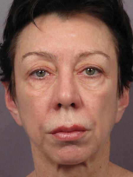 Facelift Before & After Image