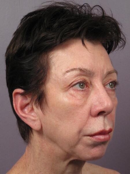 Facelift Before & After Image