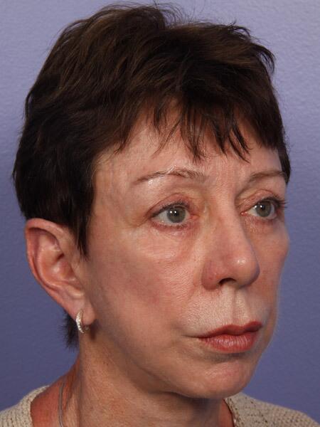 Facelift Before & After Image