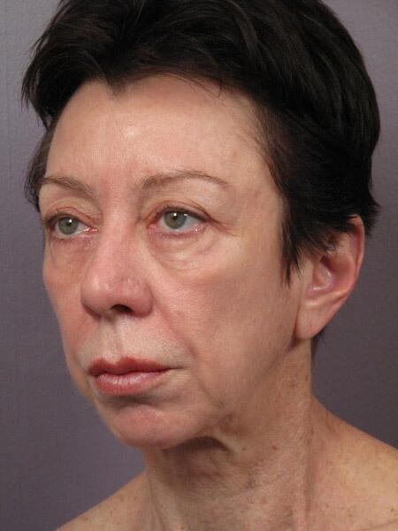 Facelift Before & After Image