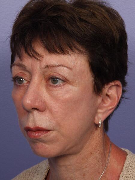 Facelift Before & After Image