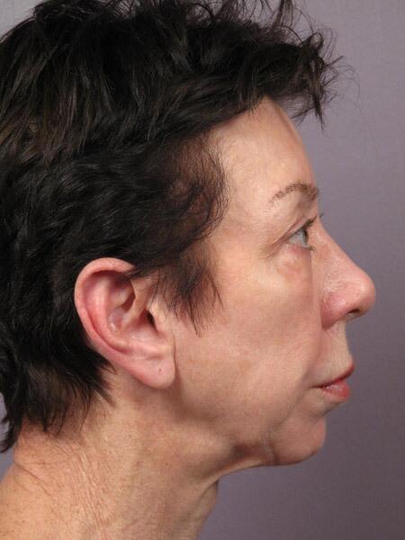 Facelift Before & After Image