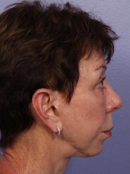 Facelift Before & After Image