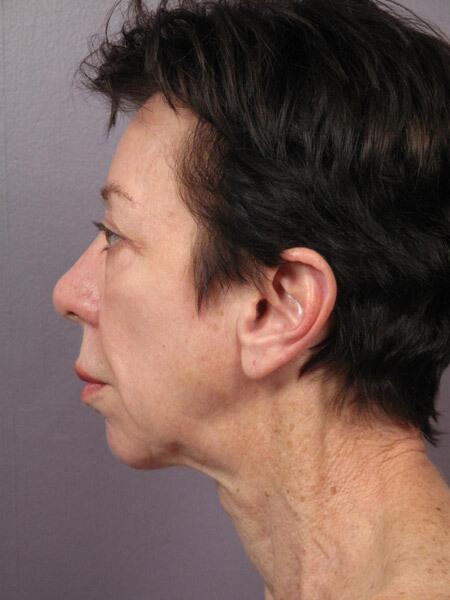 Facelift Before & After Image