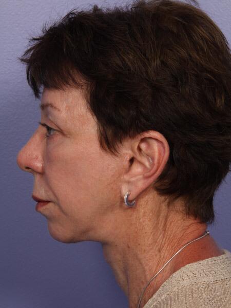 Facelift Before & After Image