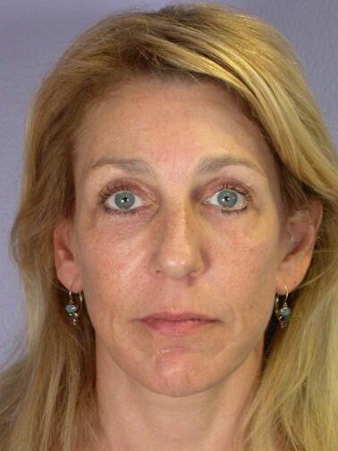 Facelift Before & After Image