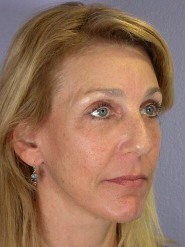 Facelift Before & After Image