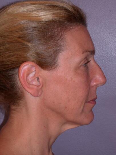 Facelift Before & After Image